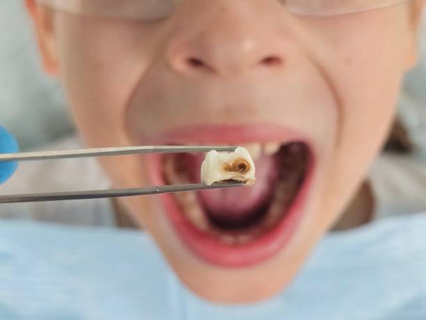 Best Emergency Dental Care for Broken or Chipped Teeth in Bolinas, CA